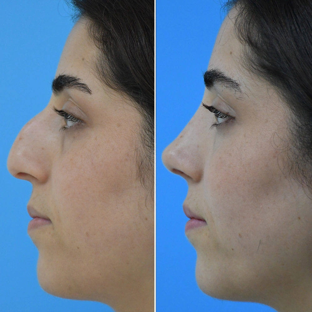 rhinoplasty